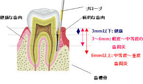 歯周病２
