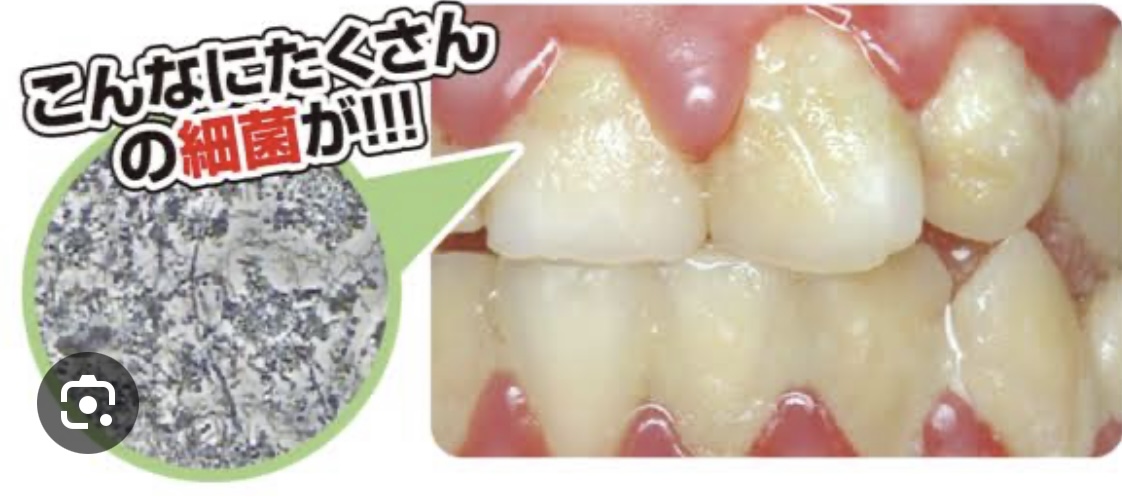 歯垢って何？ | ないとう歯科